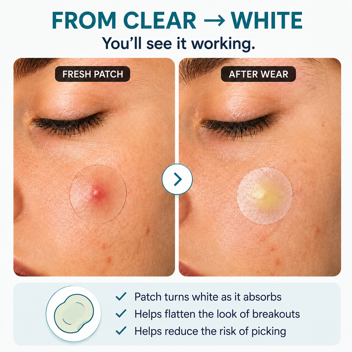 Jynvre Hydrocolloid Roll — for acne & blemishes